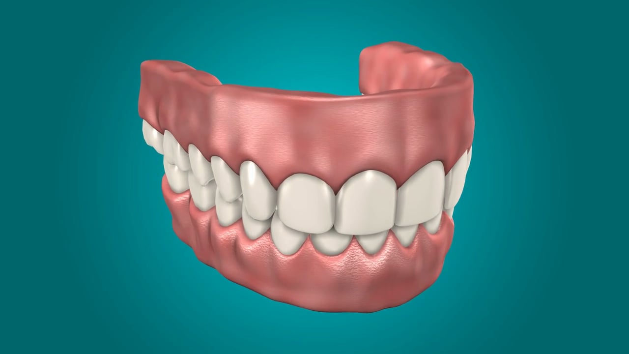 Dental implant supported overdentures